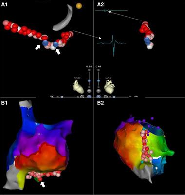 The effect of first step right atrial mapping (FRAM) on ablation duration and fluoroscopy exposure during cavotricuspid isthmus ablation of atrial flutter